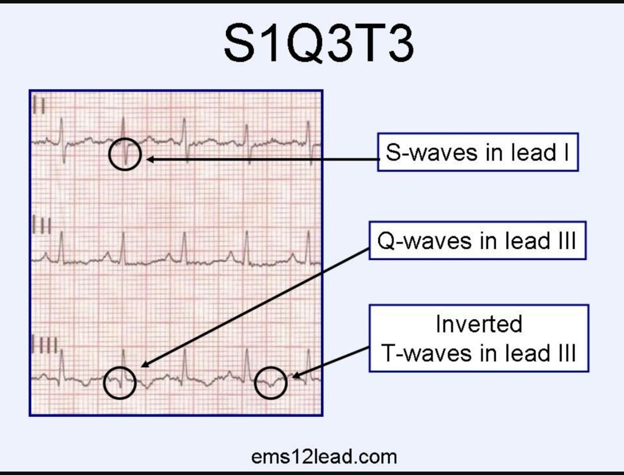 S s1. S1q3 Тип ЭКГ. S1 q3 на ЭКГ. Тэла ЭКГ s1 q3. Феномен s1 q3 t3 это.